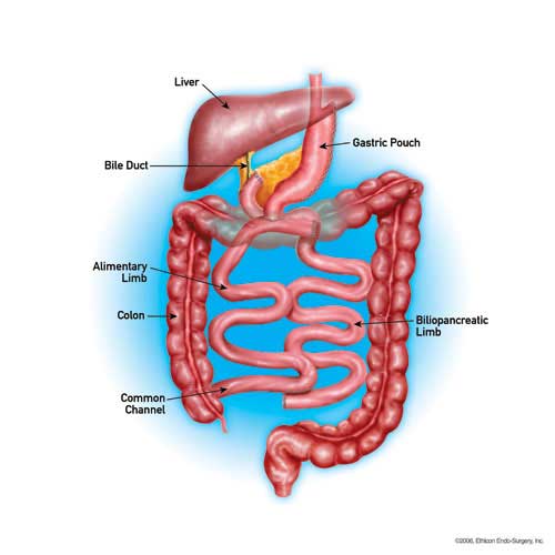 Diagram of intestines showing results of the BPD/DS process