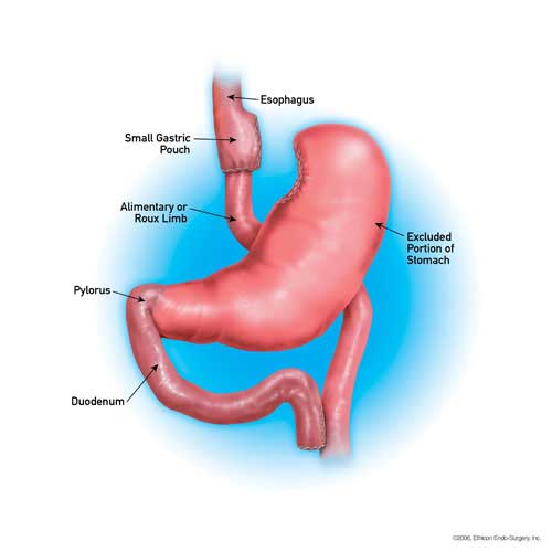 Diagram of stomach showing the excluded portion of the stomach Gastric Bypass