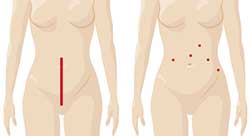 robotic gynecological surgery